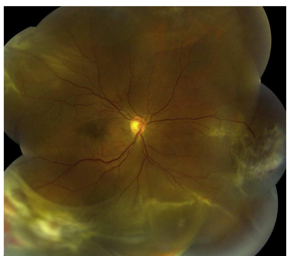 (PDF) Vitreoretinal Management and Surgical Outcomes in Proliferative ...