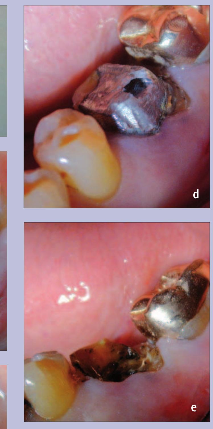 Wamkey (PDF) A practical guide to endodontic access cavity preparation in ...