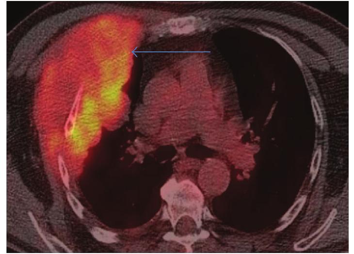 Ficure 9: axial fused pet/ct thorax at the level of the