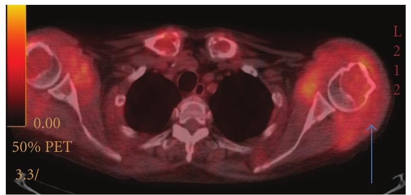 Axial fused pet/ct at the level of t2 vertebra: extensive