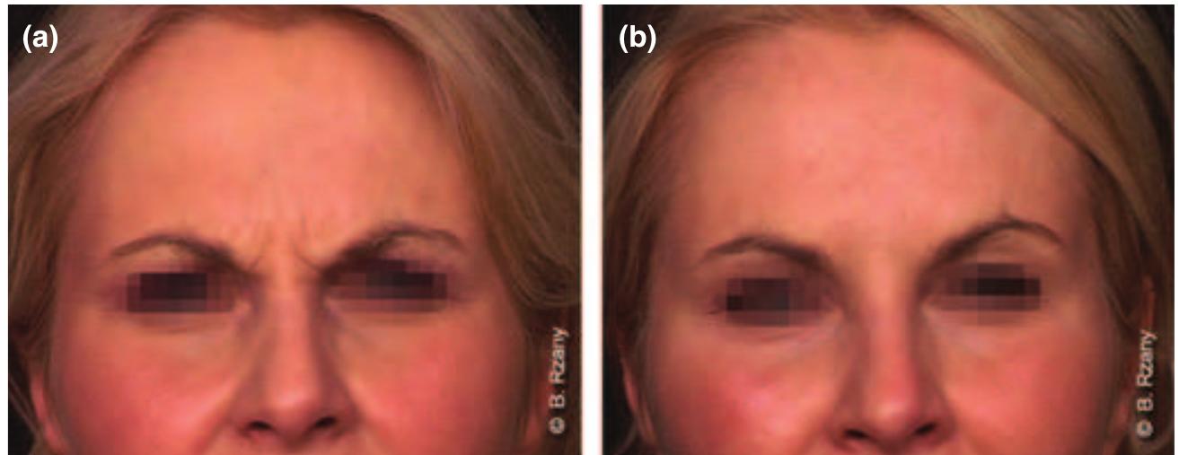 (PDF) Treatment of glabellar lines with botulinum toxin type A ...