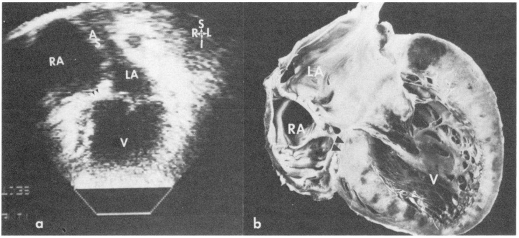 Figure 5 - from Two-dimensional echocardiographic spectrum