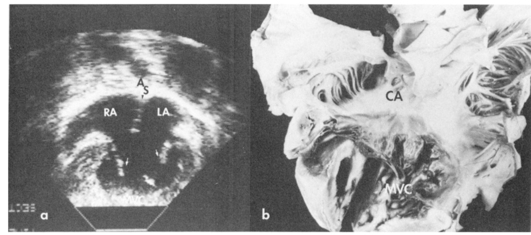 Figure 5 - from Two-dimensional echocardiographic spectrum