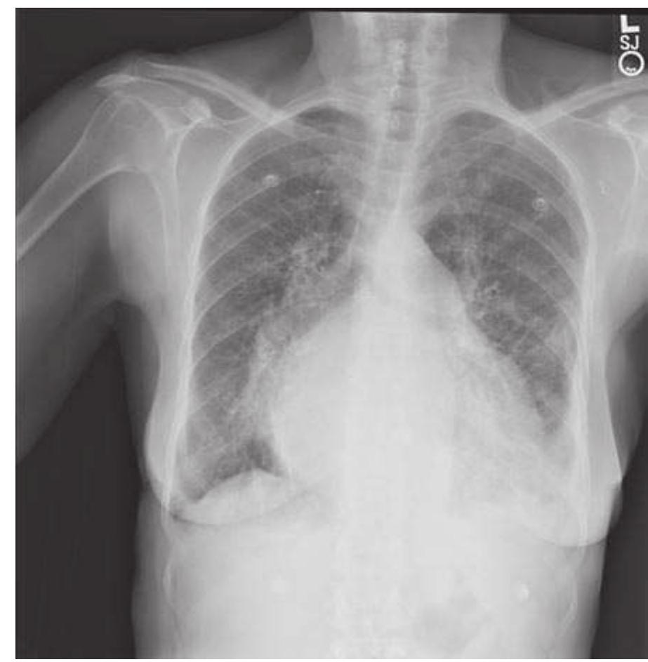 Chest radiograph of a patient with severe mitral steno- sis