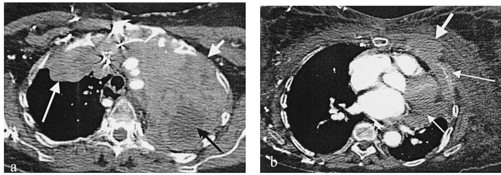 Figure 14 - from CT Evaluation of Mediastinal Masses