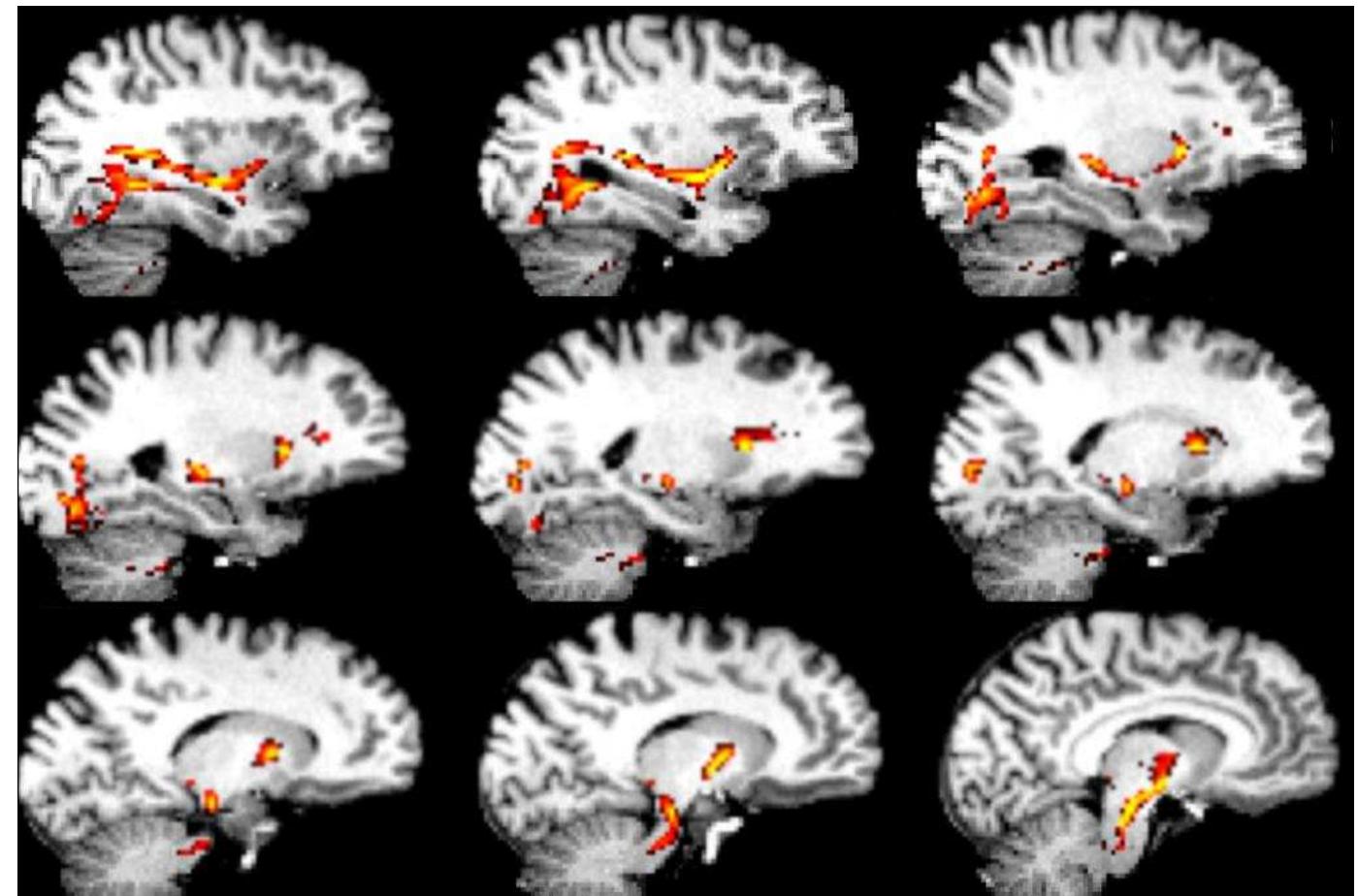 Supplementary Figure 2. Probabilistic tracts overlaid on the subject’s anatomical image that was registered to the diffusion images. The sagittal sections on the right hemisphere show possible multisynaptic pathways that the probabilistic algorithm takes from extrastriate cortex,  through the pons, and to the cerebellar pathways. 