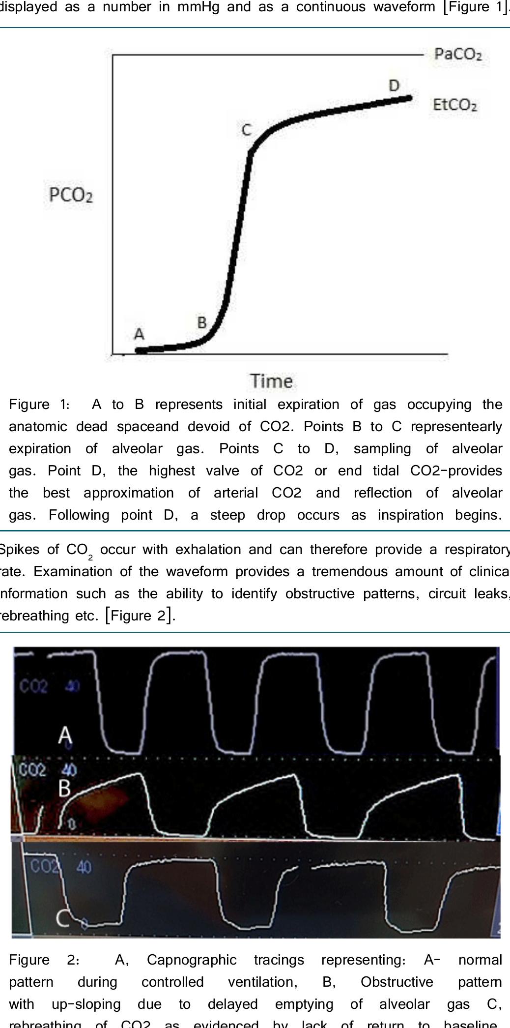 Obstructive Pattern Capnography Arterial waveforms a: damping of the tracing with loss of