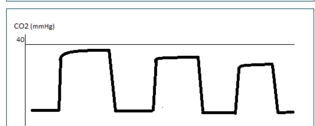 Obstructive Pattern Capnography Arterial waveforms a: damping of the tracing with loss of