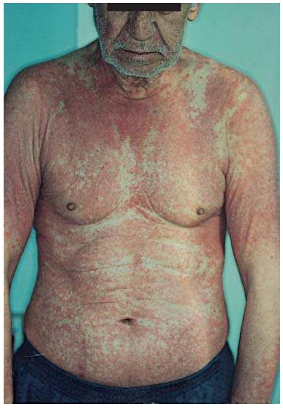 Extensive eczematous rash with erythematous, slightly scaly