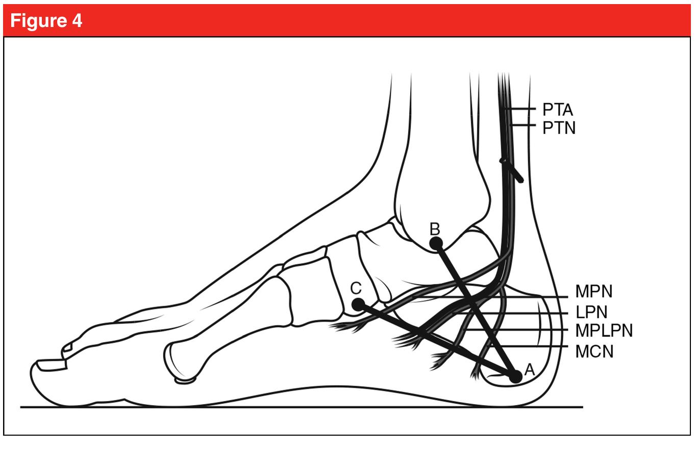 Lp Risks Nerve Illustration demonstrating the nerves most at risk during