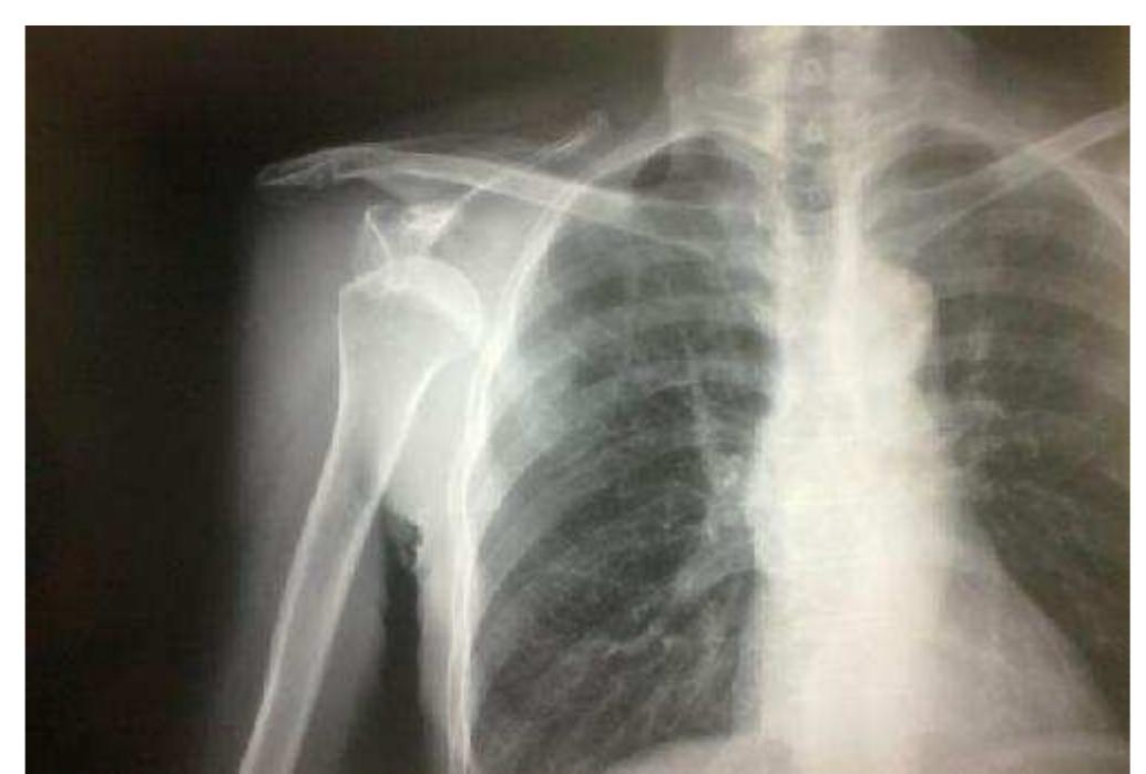 Dislocation Real Image Radiograph of the injury showing dislocation. discussion