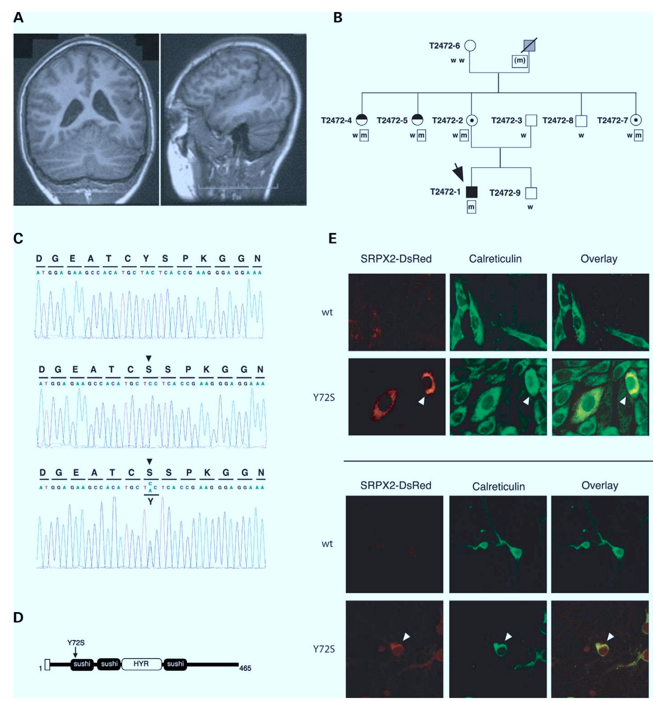 (PDF) SRPX2 mutations in disorders of language cortex and cognition