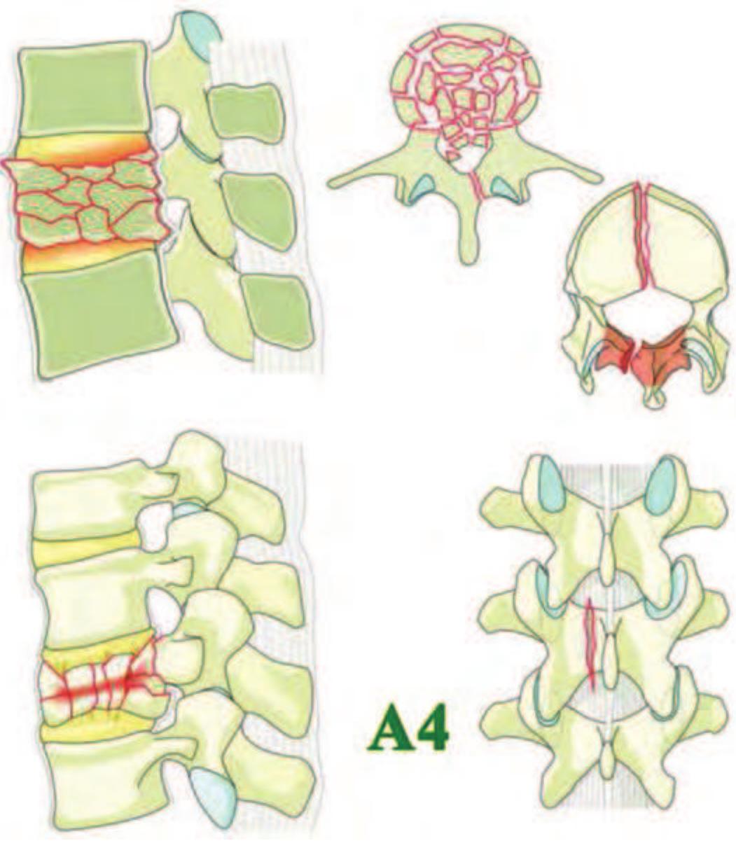 (PDF) AOSpine Thoracolumbar Spine Injury Classification System