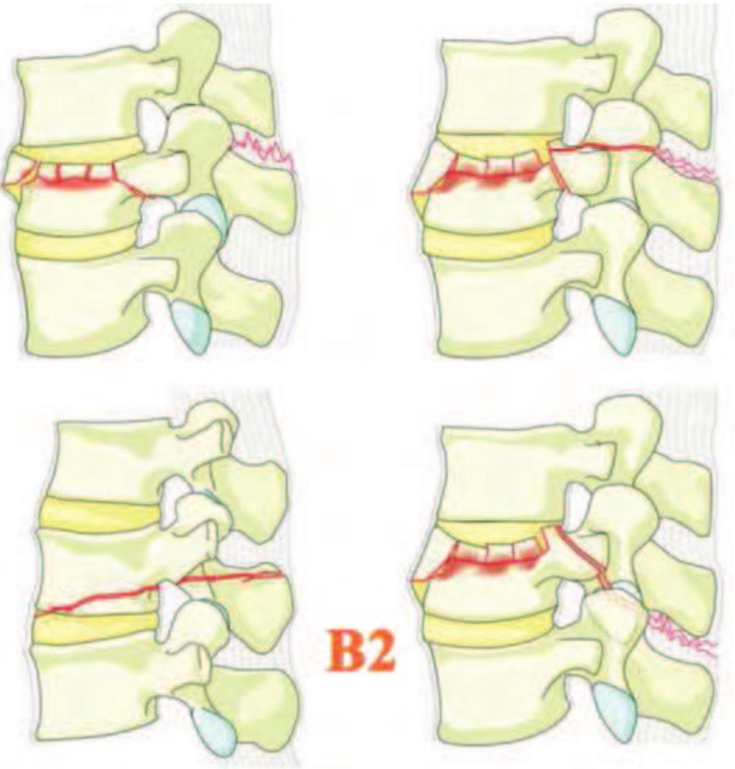 (PDF) AOSpine Thoracolumbar Spine Injury Classification System