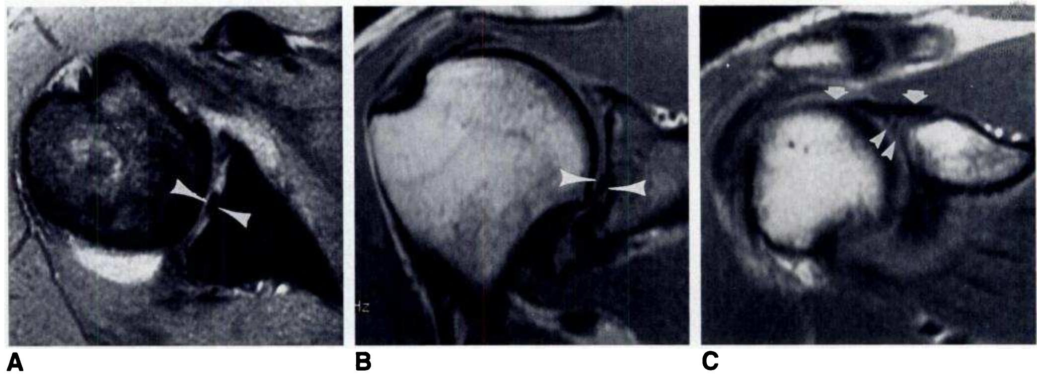 Figure 3 - from Superior Labral Anteroposterior Lesions of