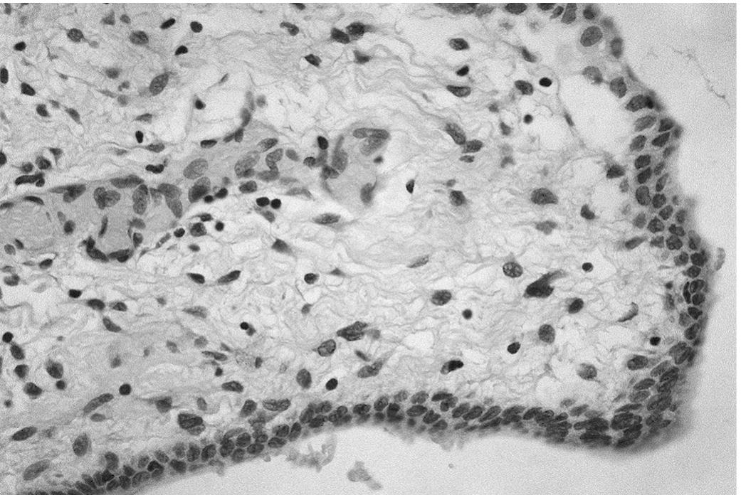 Photomicrograph of a cyst with a thick wall composed of