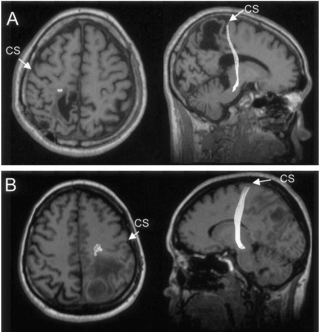 Trafitional Mri Transverse and sagittal t1-weighted mri scans of patients 24