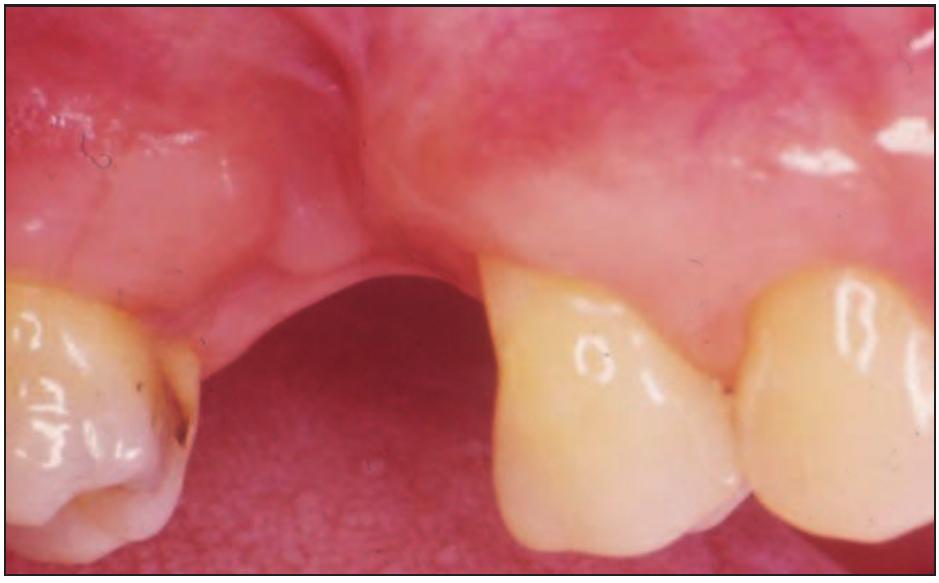(PDF) Socket preservation as a precursor of future implant placement ...