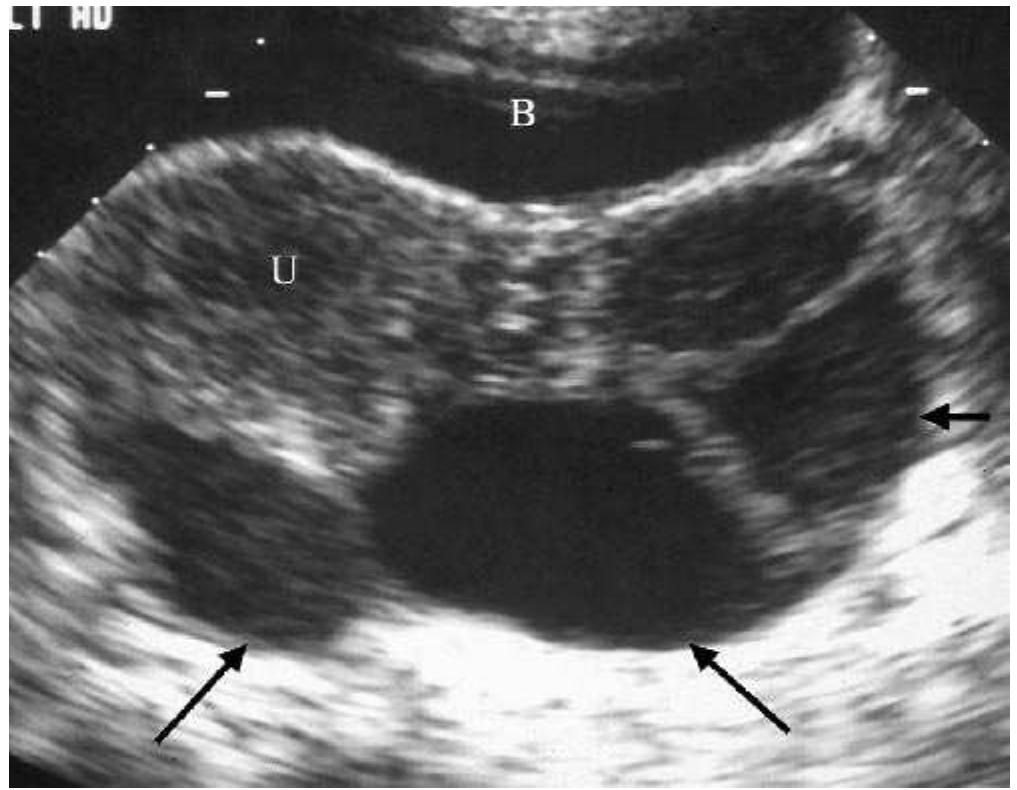 Tuboovarian abscess (toa). pelvic us. transverse plane. ar-