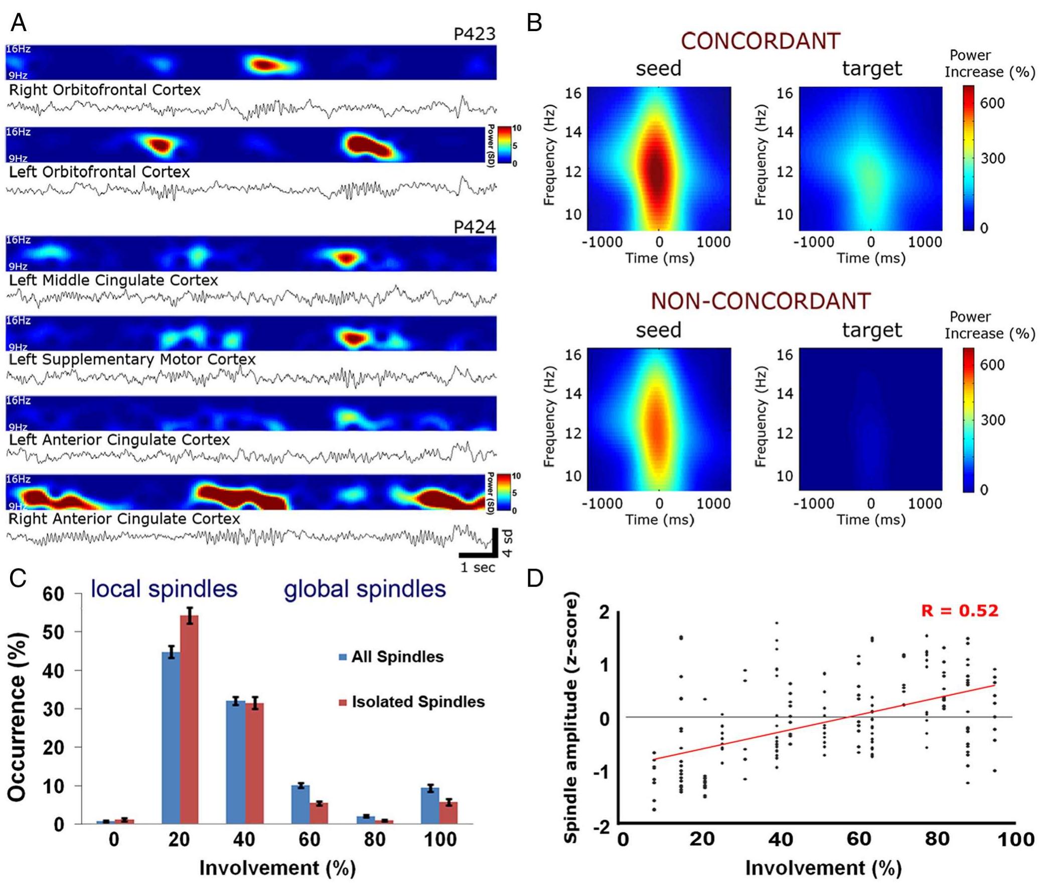 (PDF) Sleep Spindles in Humans: Insights from Intracranial EEG and Unit ...