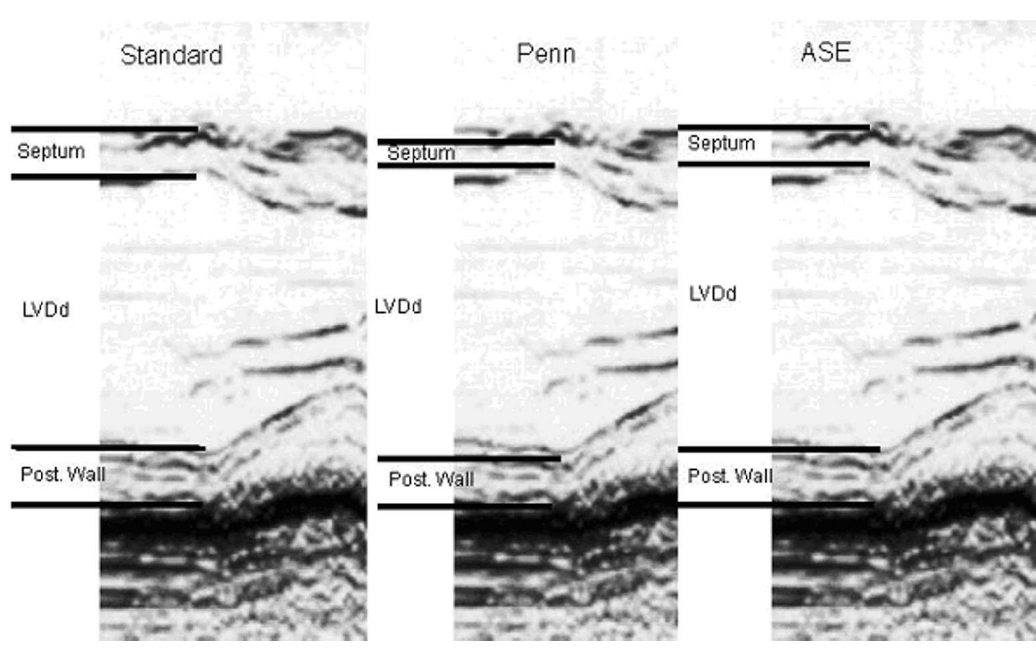 Adapted from[18]. table 2: left ventricular hypertrophy cut