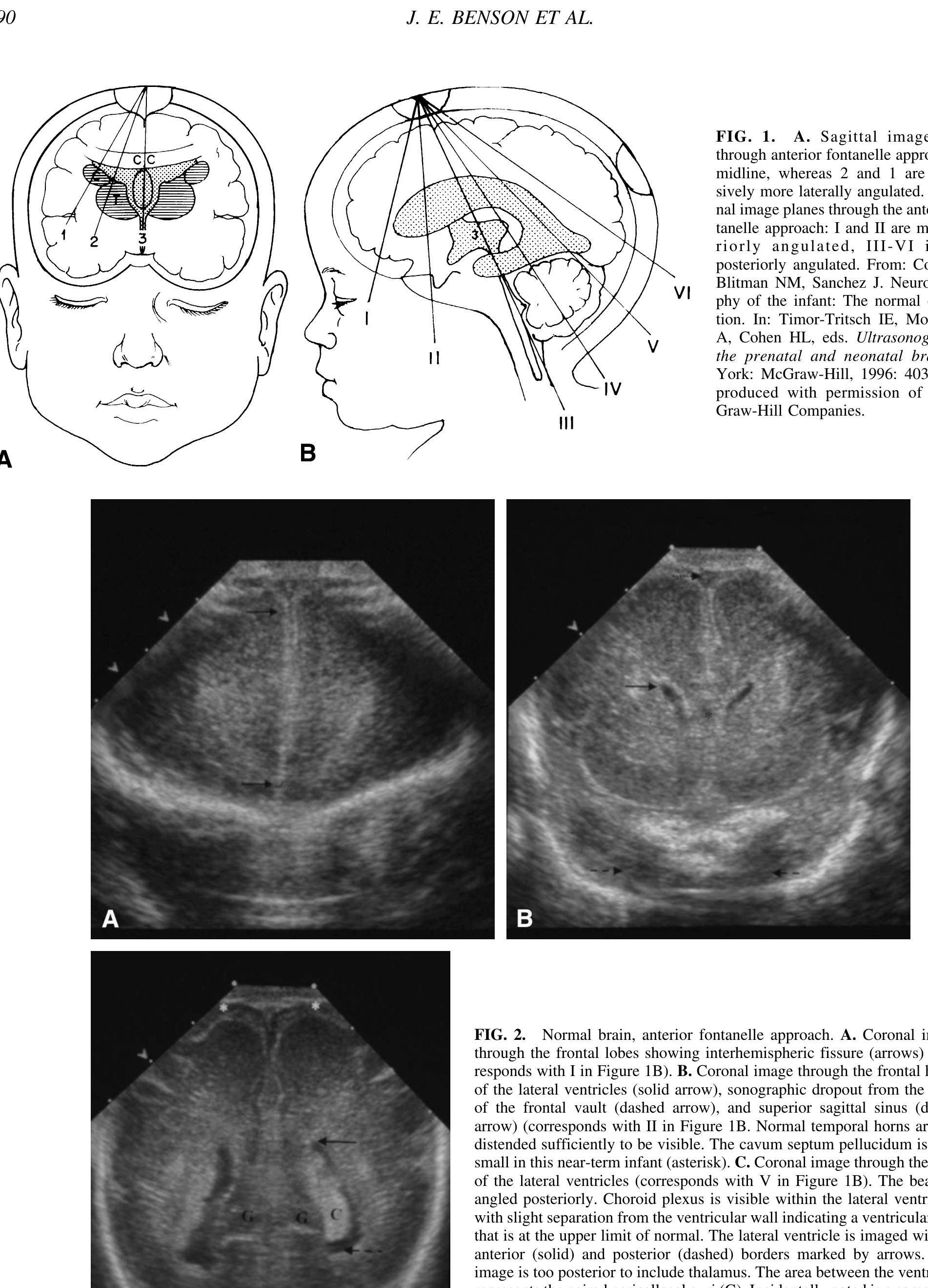Figure 1 - Intracranial Neonatal Neurosonography: An Update