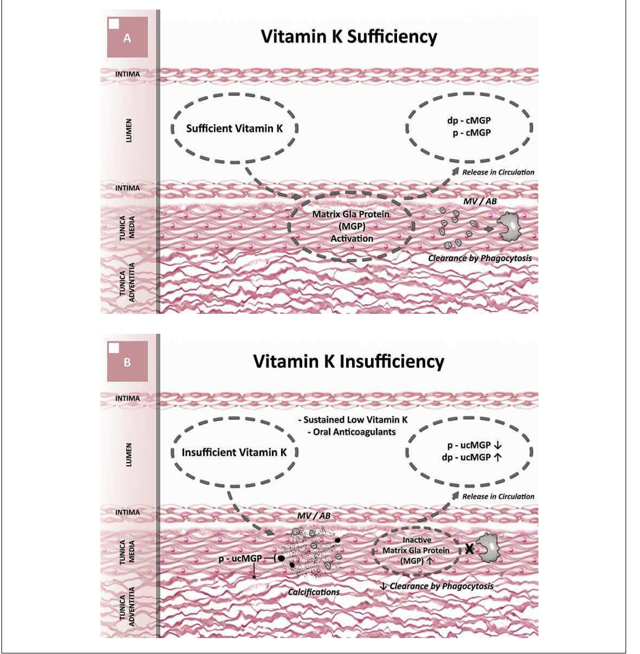 (PDF) Matrix Gla-protein: The calcification inhibitor in need of vitamin K