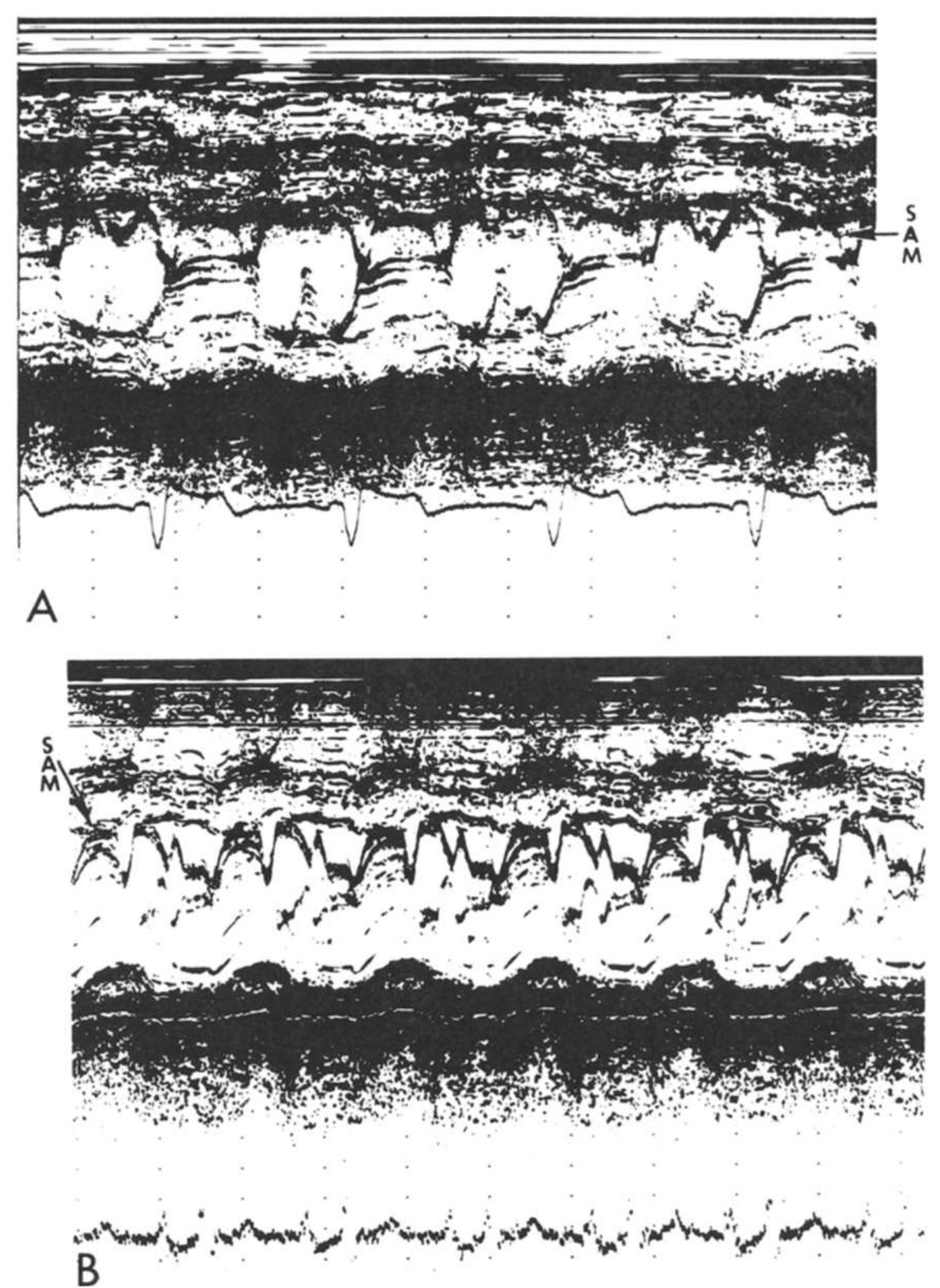 (PDF) Echocardiography in valvular heart disease