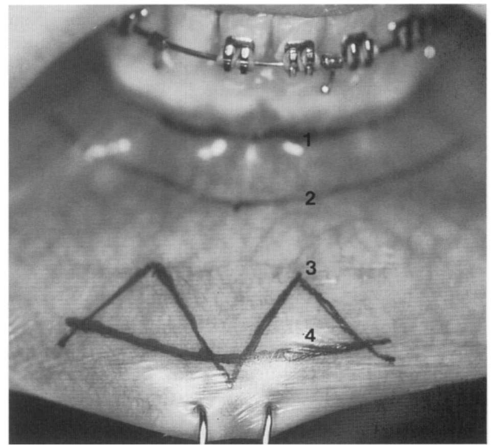 Sublabial Excision (PDF) High labial incisions for genioplasty