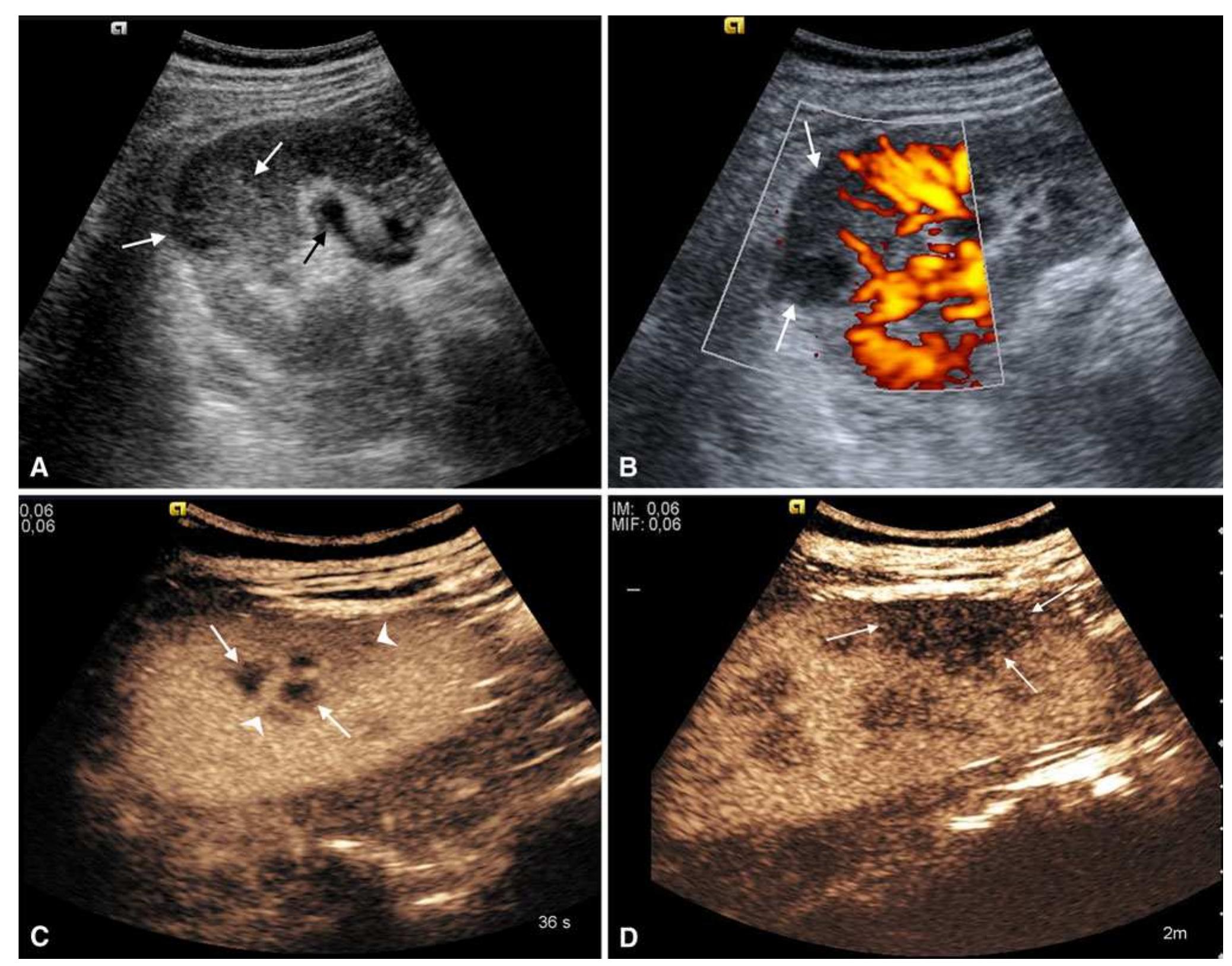 (PDF) Acute complicated pyelonephritis: contrast-enhanced ultrasound