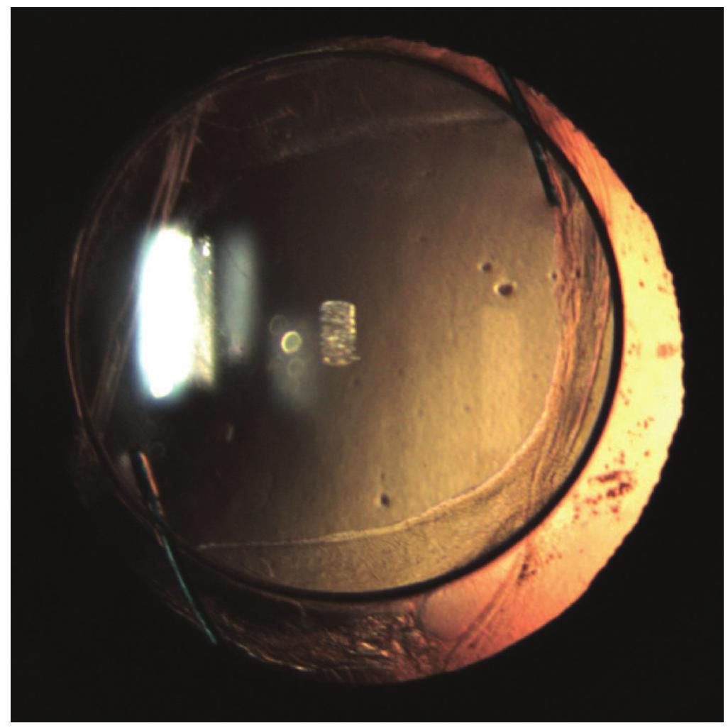(PDF) Complications of cataract surgery