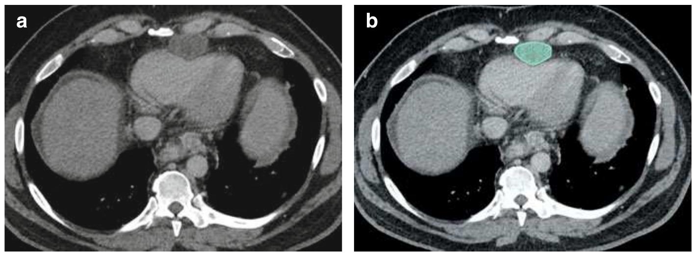 38 (a, b) axial contrast-enhanced ct scan of the thorax