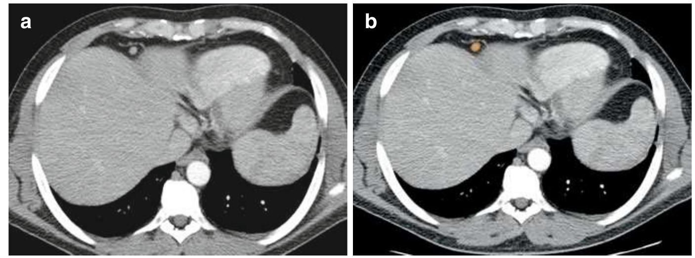 40 (a, b) axial contrast-enhanced ct scan of the thorax
