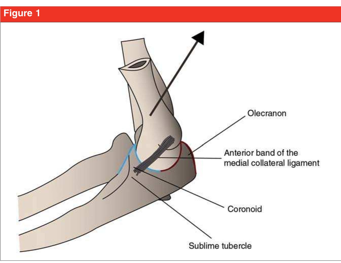 Ulna Varus (PDF) Management of Fractures of the Proximal Ulna