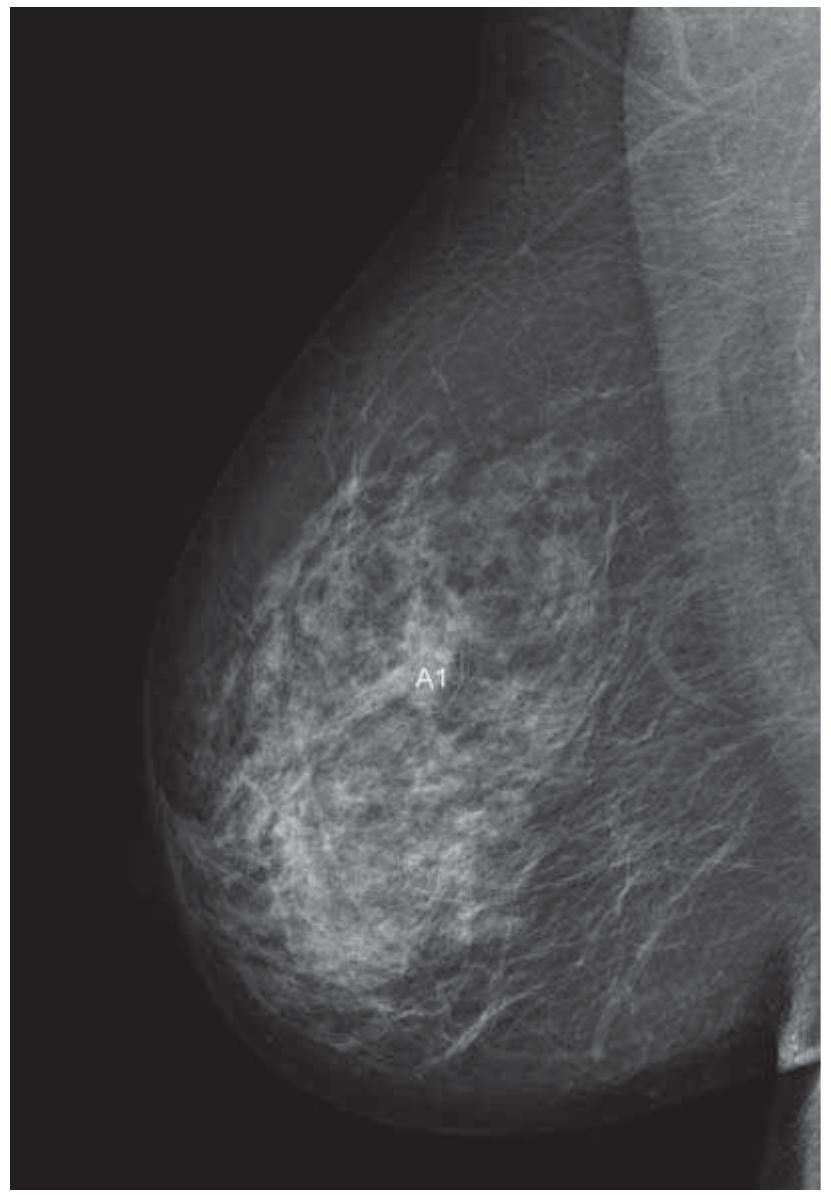 (PDF) Delineation of target volumes and organs at risk in adjuvant ...