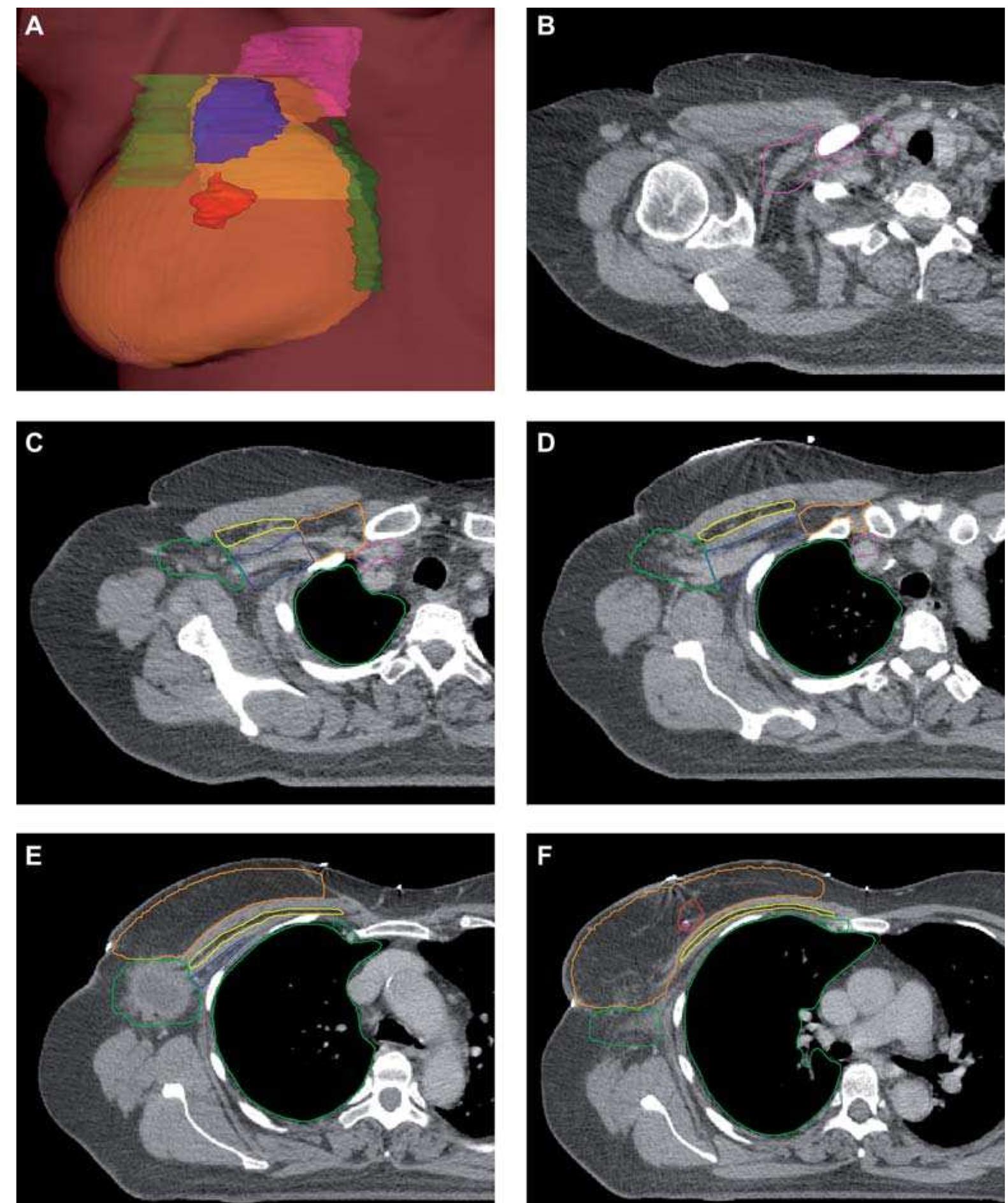 (PDF) Delineation of target volumes and organs at risk in adjuvant ...
