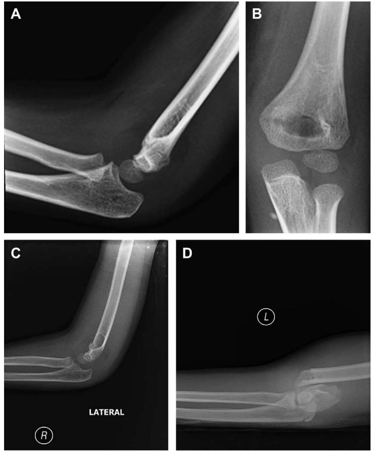 Supracondylar fracture type |. (a) lateral view. notice the