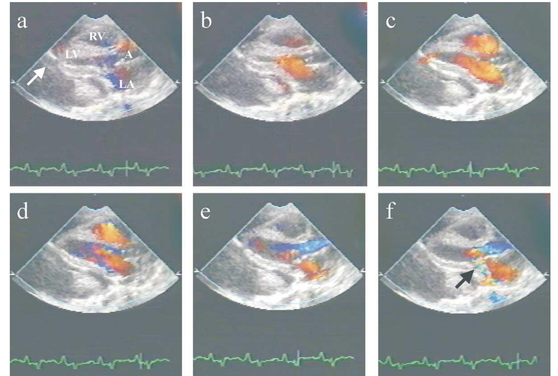 (PDF) Lesions of the pericardium and their significance in the ...