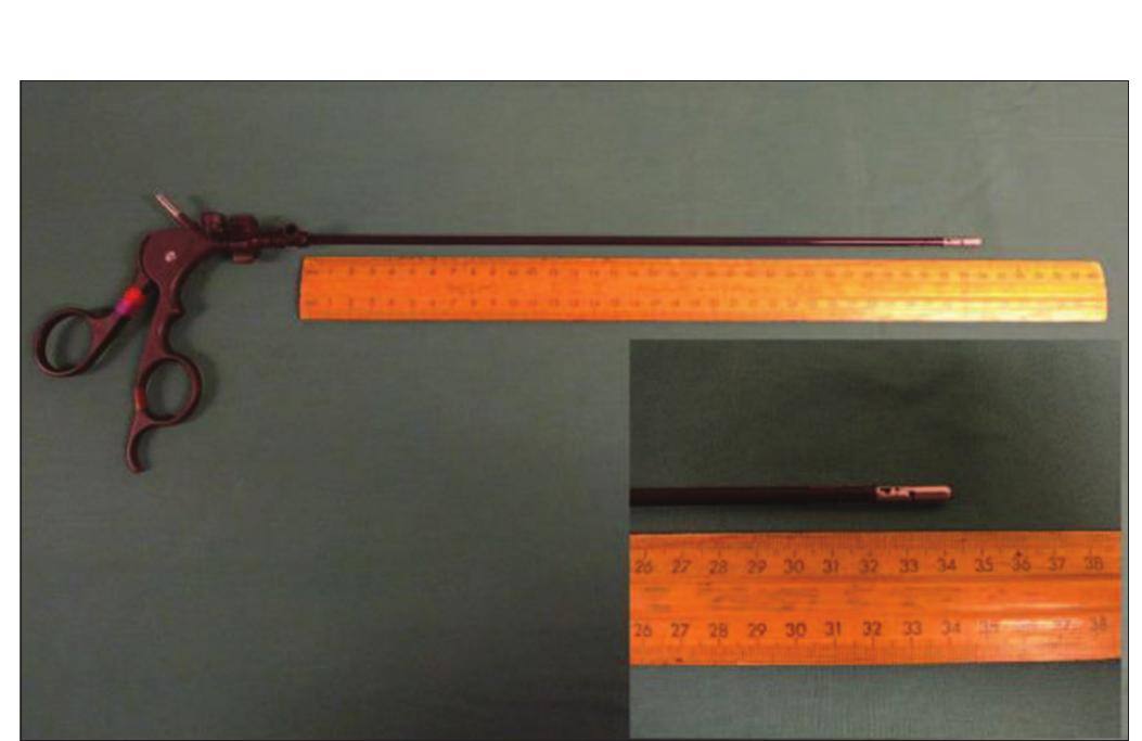 case-1-photograph-shows-the-laparoscopic-grasper-measuring