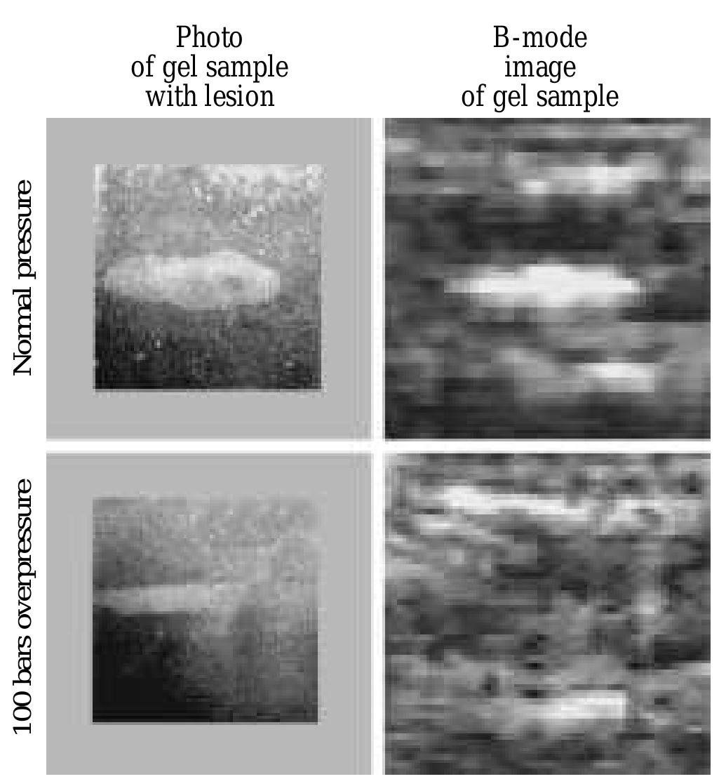 Hifu lesions (left) in transparent gel phantom and b-mode