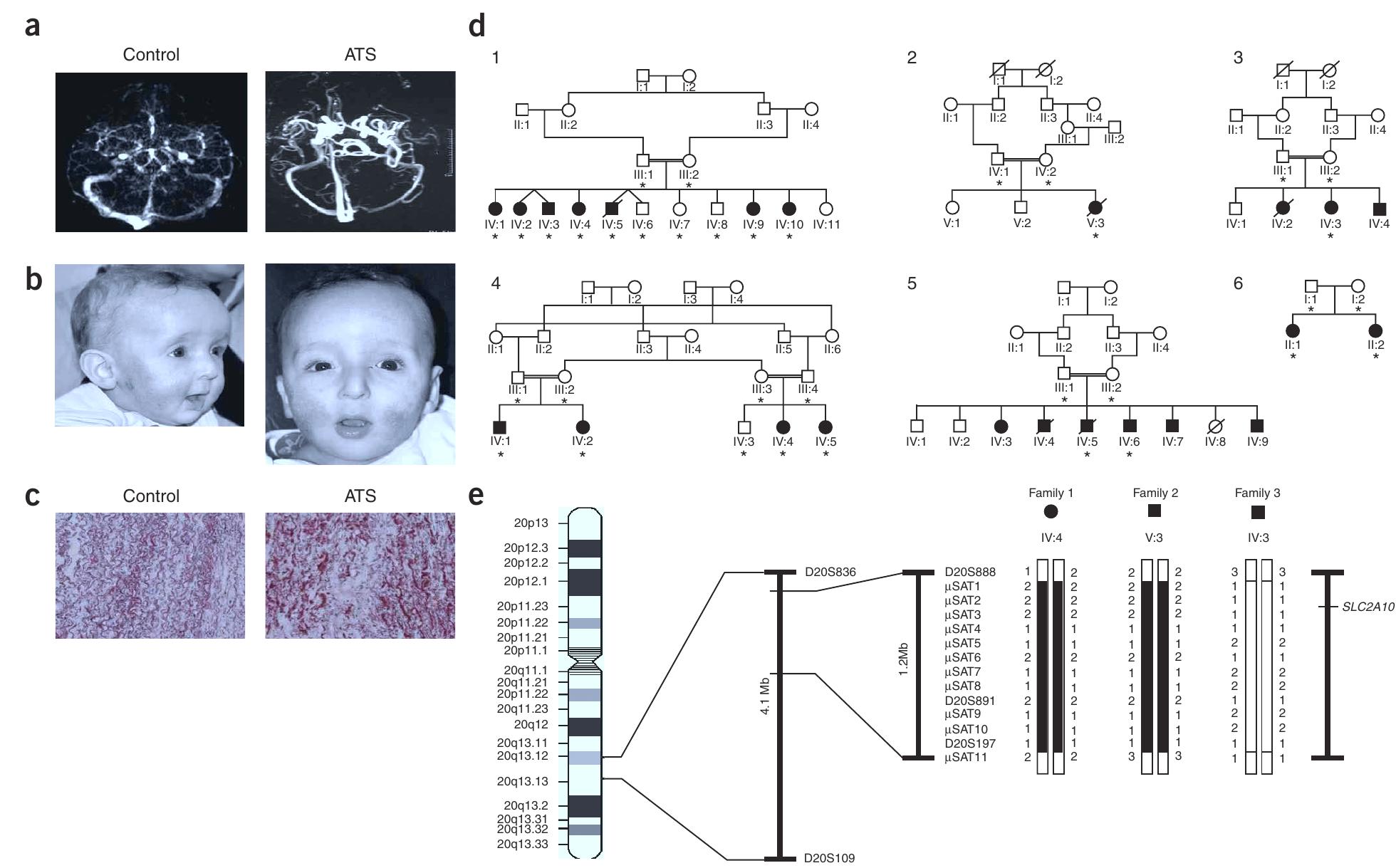 PDF) Arterial tortuosity syndrome: clinical and molecular findings