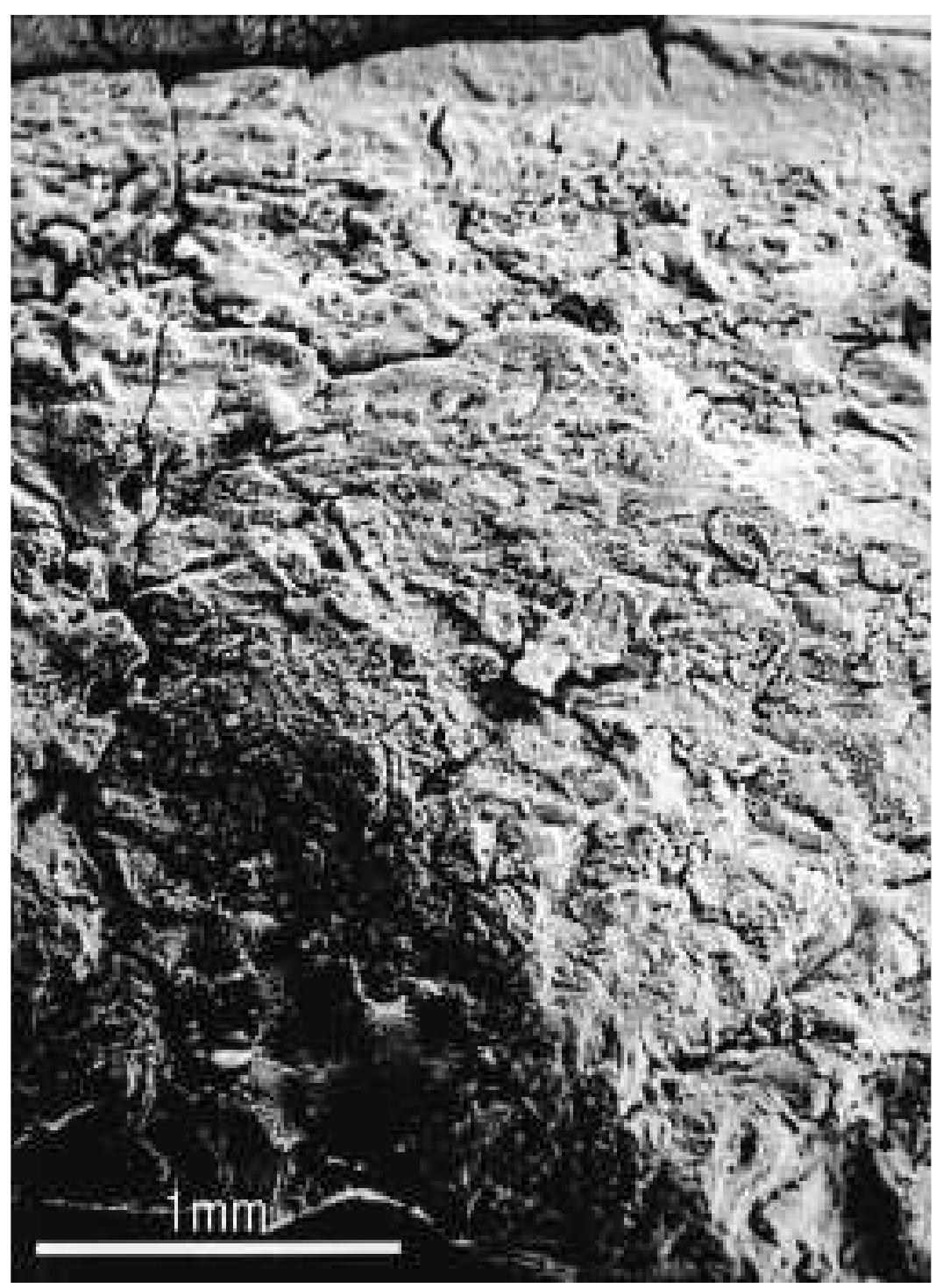 burned traumatically induced perpendicular fracture sur-