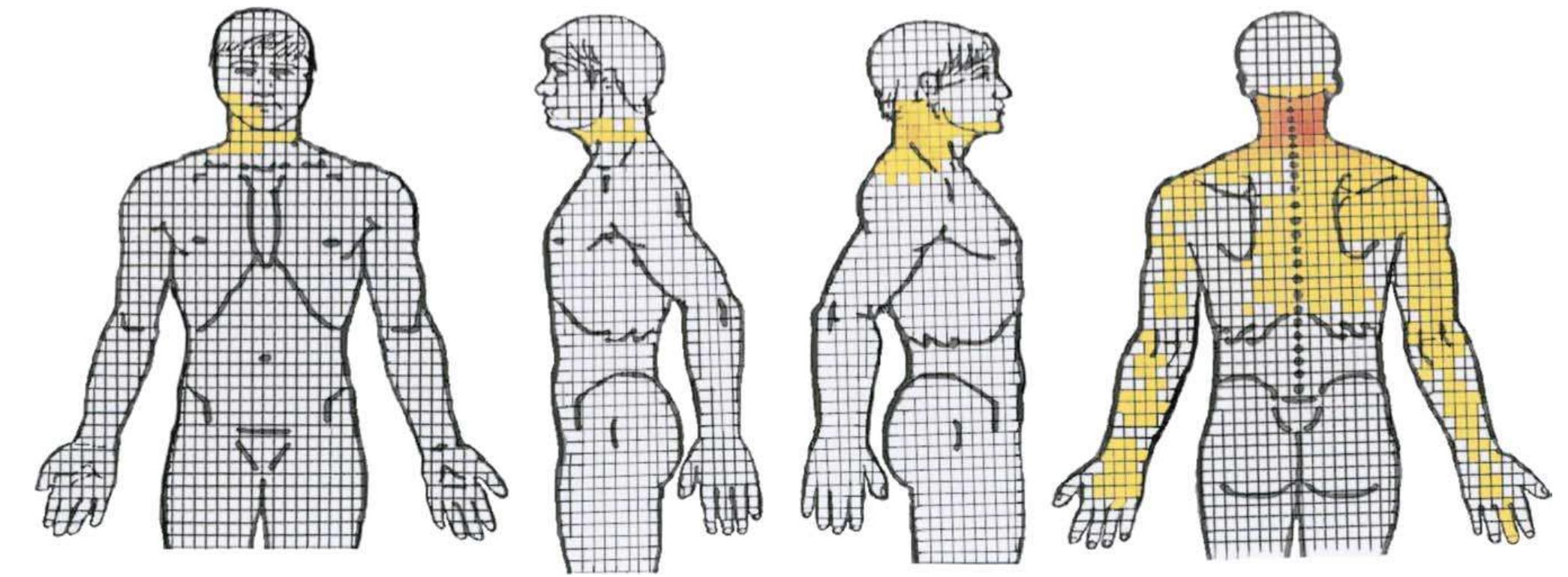 Figure 1 - from Provocative cervical discography symptom