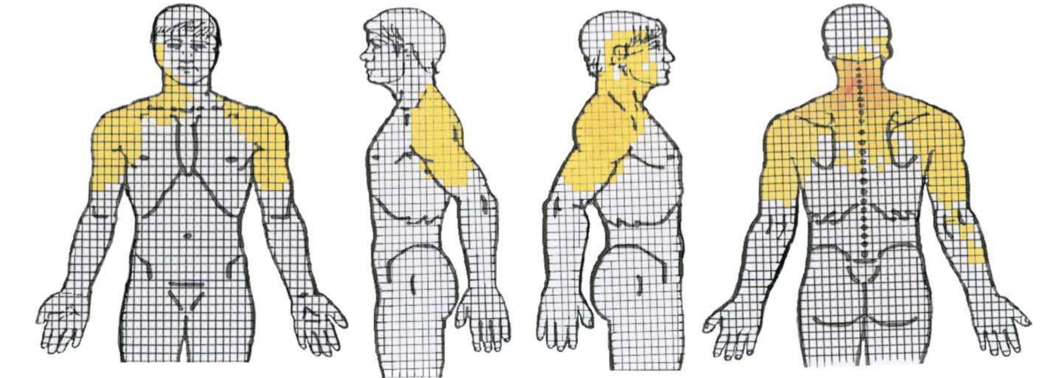 Figure 1 - from Provocative cervical discography symptom