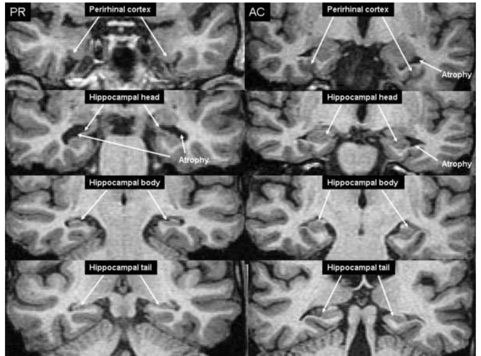 T1 weighted coronal images through the temporal lobe showing