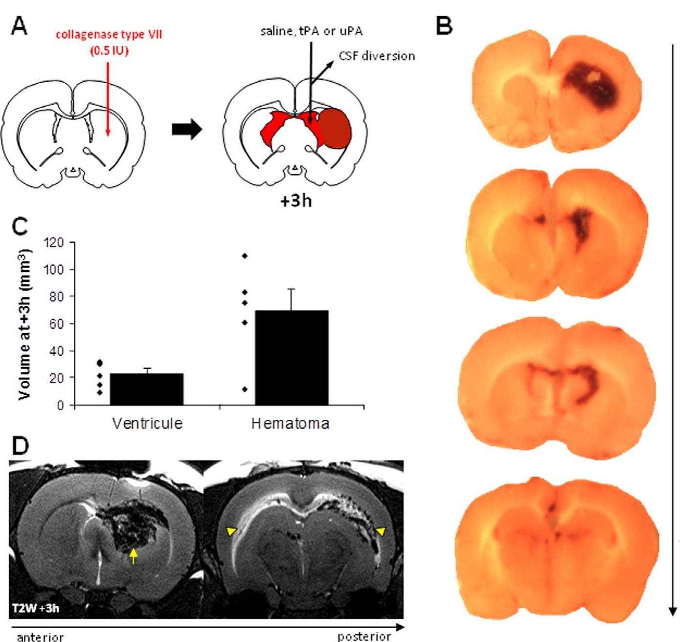 (PDF) Urokinase versus Alteplase for intraventricular hemorrhage ...