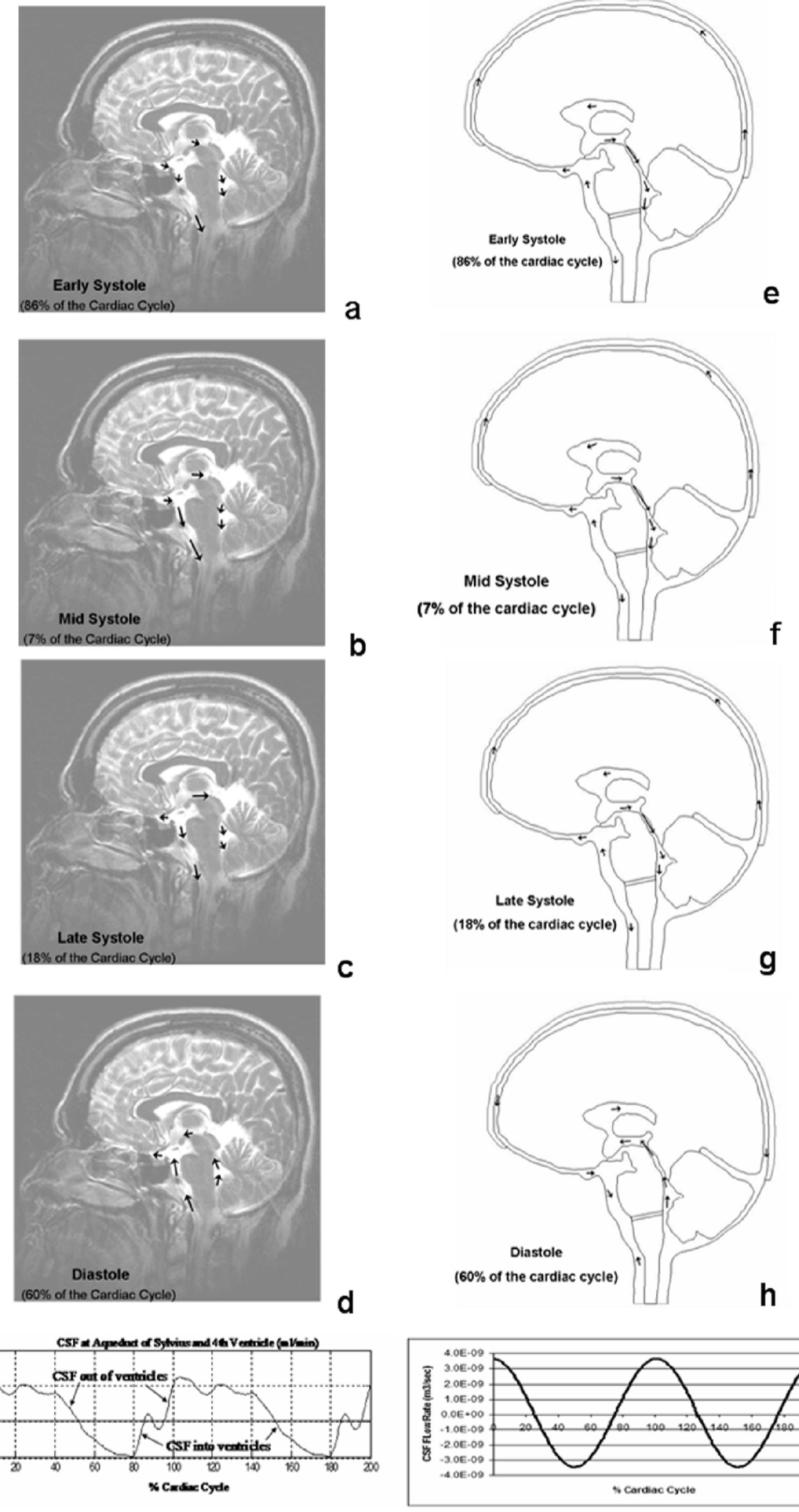 Figure 4 - Cerebrospinal Fluid Flow in the Normal and