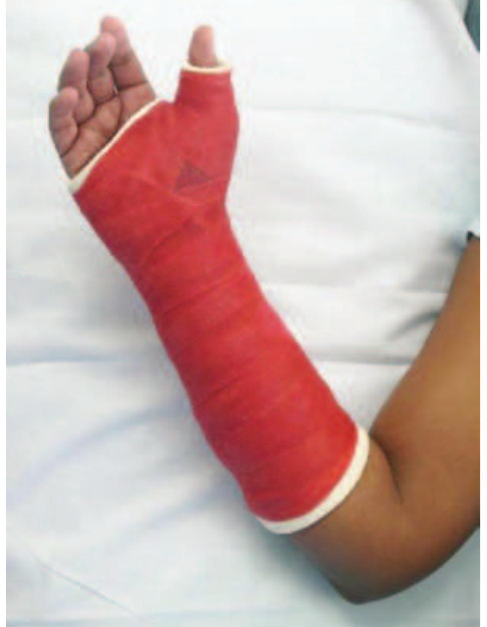 Figure 6 - Splints and casts: indications and methods