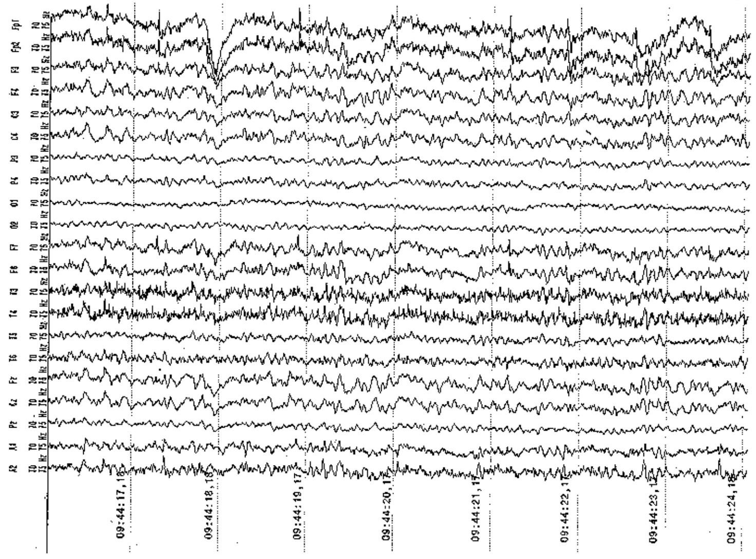Eeg record for patient # 3 (dorsal meningeoma). the third