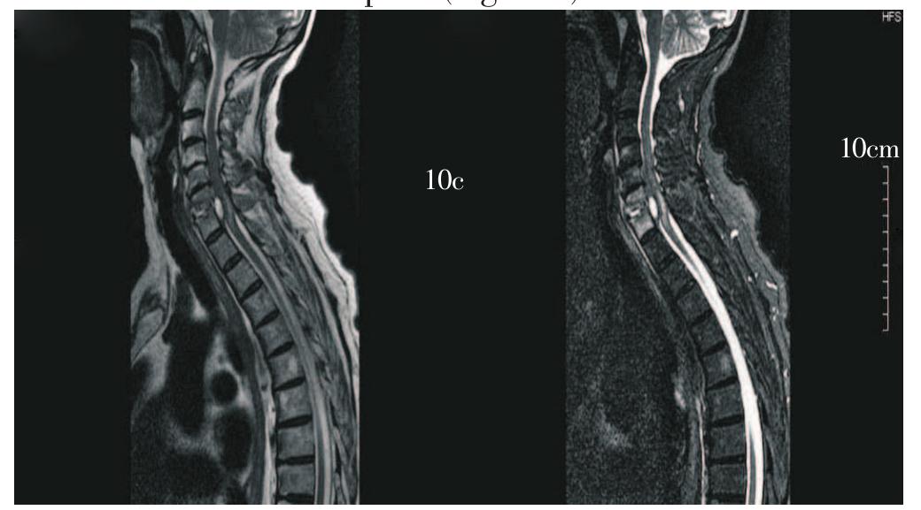 Figure 6 - from Acute flaccid paraplegia: neurological